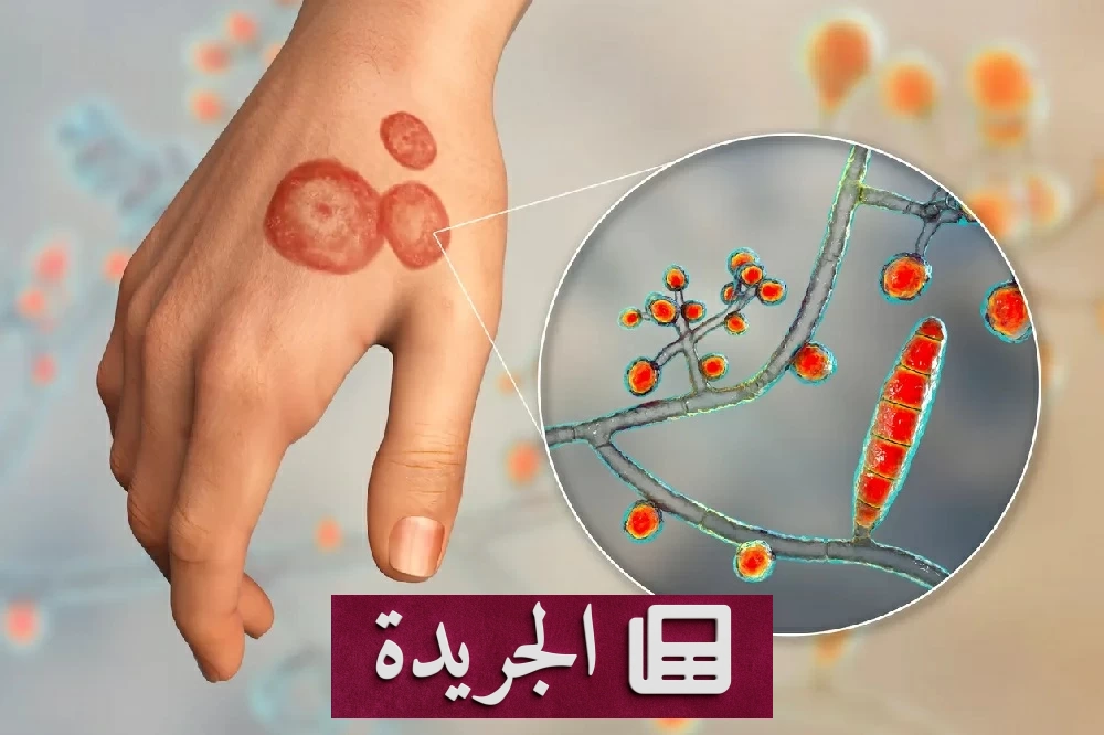 انتشار فطر جلدي مقاوم للعلاج يثير قلق الأطباء عالمياً - آخر أخبار الجريدة