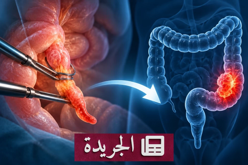 دراسة تكشف دور جراحة الزائدة الدودية في خفض خطر الإصابة بسرطان القولون - آخر الأخبار - الجريدة