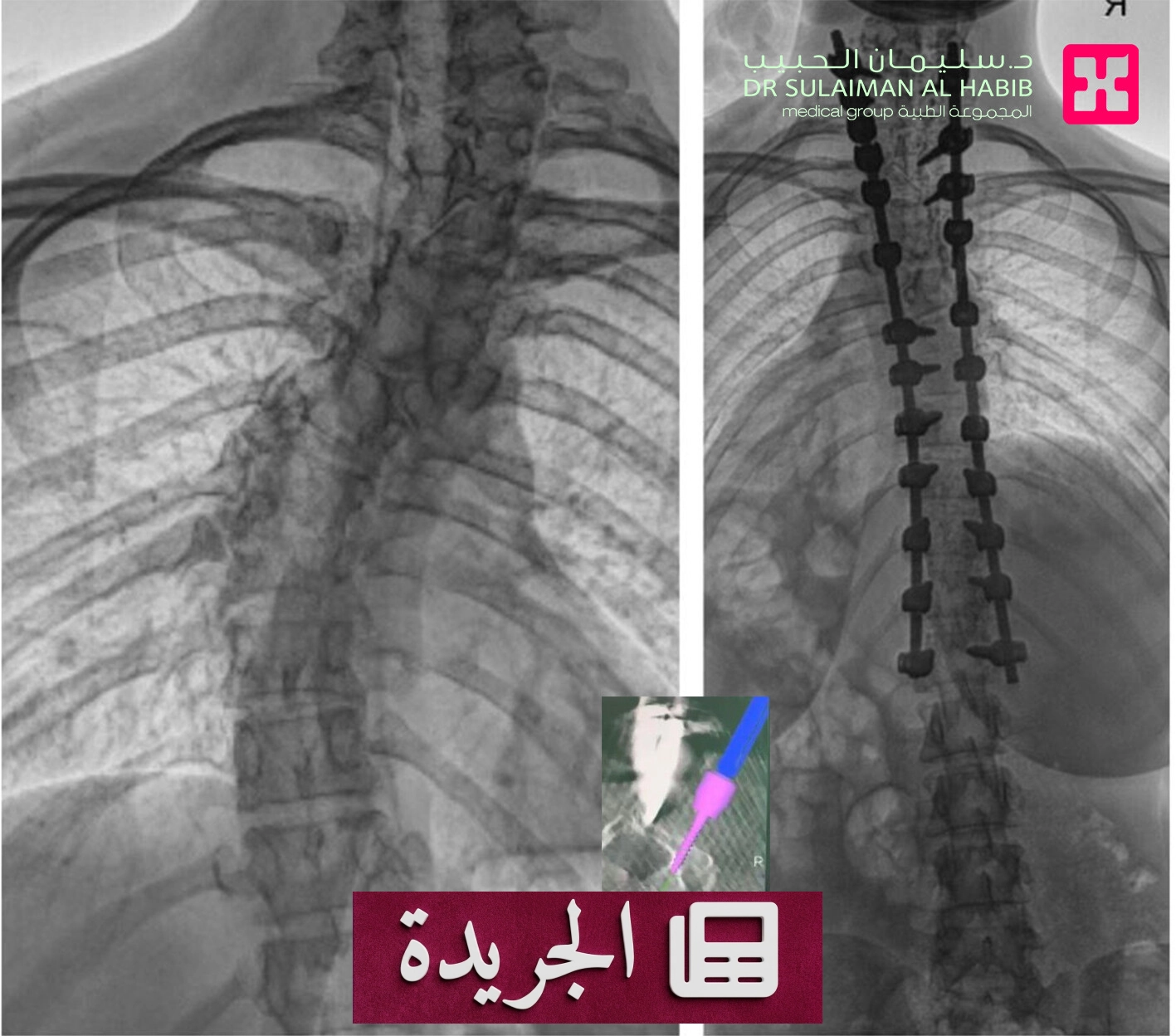 نجاح عملية جراحية معقدة لإنقاذ فتاة من الجنف الخلقي بزاوية 46 درجة - آخر الأخبار - الجريدة