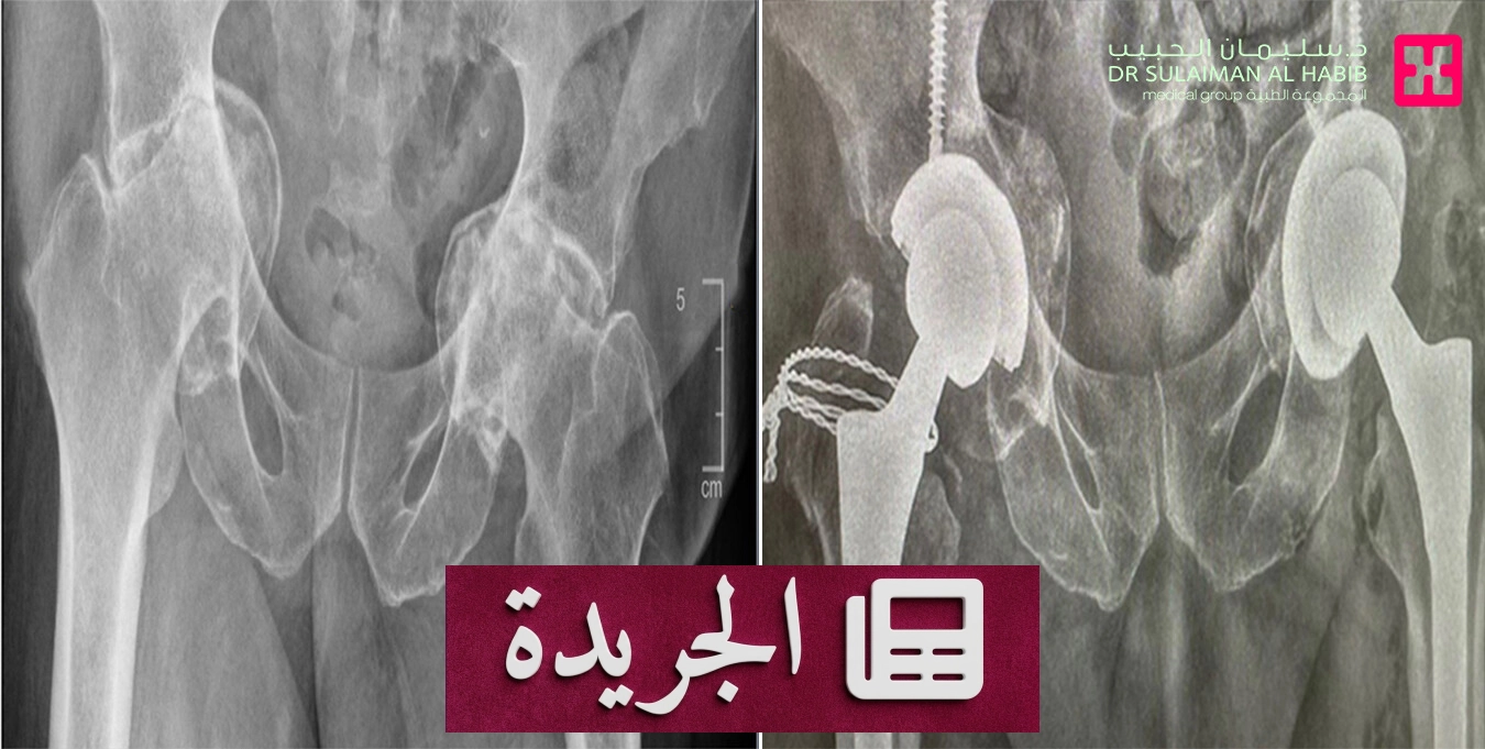 نجاح جراحة معقدة لاستعادة الحركة لمريض مقعد لسنوات - آخر الأخبار - الجريدة