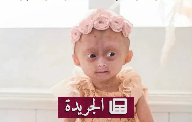 رحيل الطفلة البرازيلية إيليس ليما كارنيرو بعد صراع مع الشيخوخة المبكرة - آخر الأخبار - الجريدة