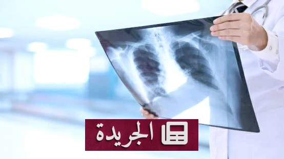 اكتشاف آلية جديدة لعلاج السل يعزز الأمل في مواجهة المقاومة الدوائية - أخبار أونلاين