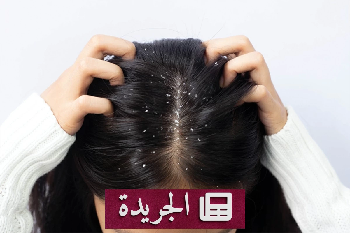 اكتشاف طبي مفاجئ.. هل تسبب قشرة الرأس في تساقط الشعر حقاً؟ - آخر أخبار الجريدة