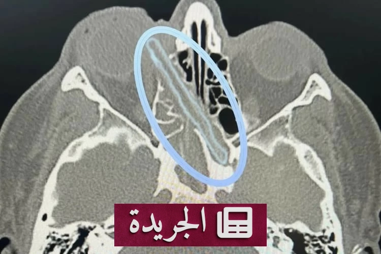 اكتشاف طبي صادم غصناً خشبياً داخل جمجمة رجل روسي - آخر الأخبار - الجريدة