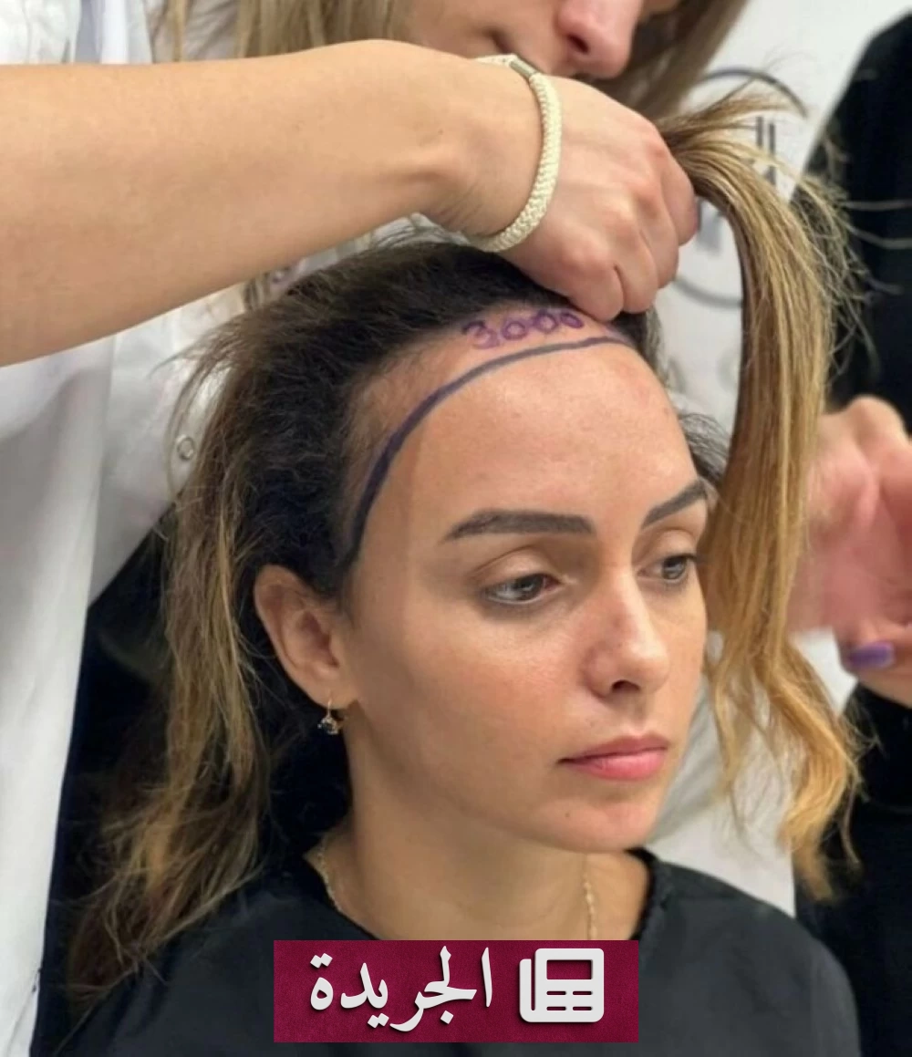 ارتفاع الإقبال على زراعة الشعر للنساء بفضل التقنيات الحديثة - أخبار أونلاين