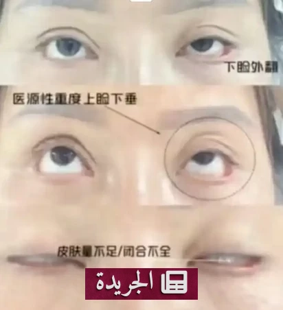ضحية تشويه جفن العين في الصين تدفع غرامة مالية باهظة بسبب شرط جزائي - آخر الأخبار - الجريدة