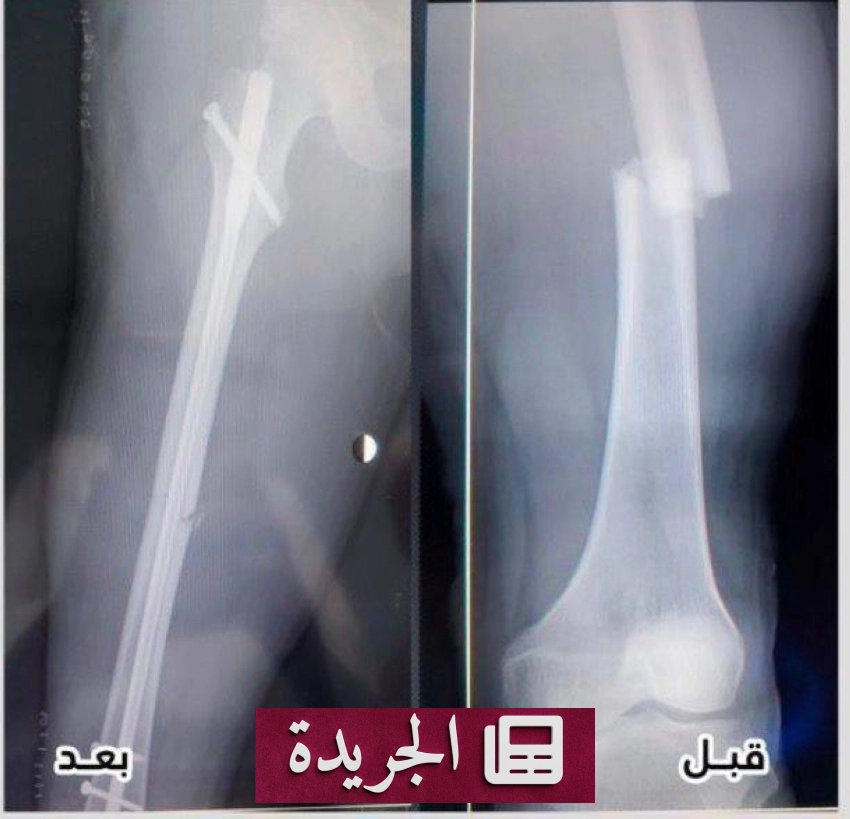 نجاح عملية جراحية عاجلة لإنقاذ قدم رجل بعد سقوط من ارتفاع في مستشفى بدر - أخبار أونلاين