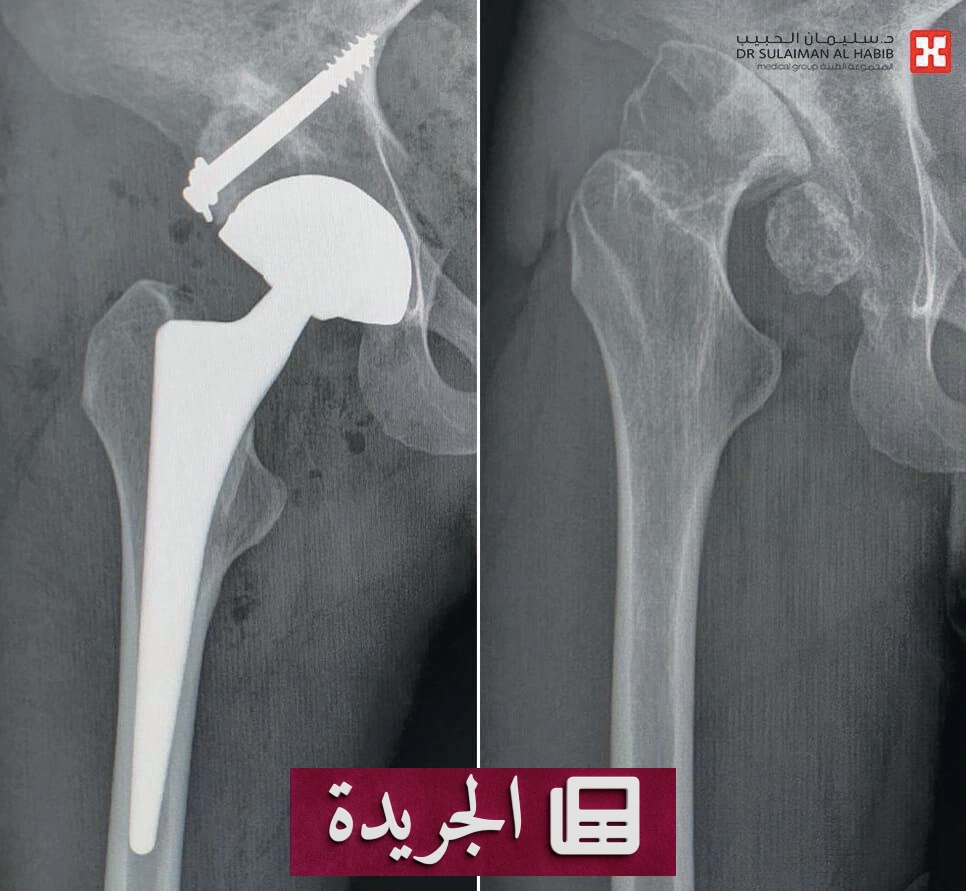 نجاح عملية جراحية لاستبدال مفصل الورك في مستشفى الدكتور سليمان الحبيب - آخر الأخبار - الجريدة