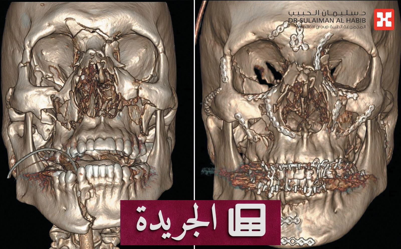 نجاح عملية جراحية معقدة لإعادة بناء وجه شاب بعد حادث مروري - آخر الأخبار - الجريدة